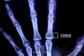13岁男孩过度进补，一天吃四顿身高定格170