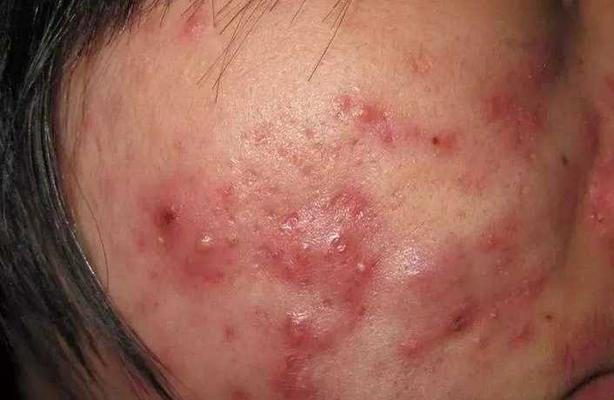 如何有效去除青春痘的方法（告别烦恼）  第2张